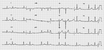 房性早搏二联律Atrial Bigeminy