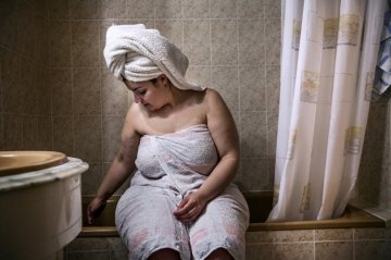 蜕变：西班牙女子手术减肥