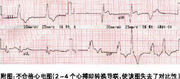 心电图诊断步骤及要点