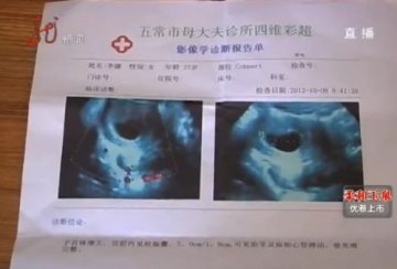 五常市人民医院误诊孕妇死胎 打胎后十天死胎“复活”