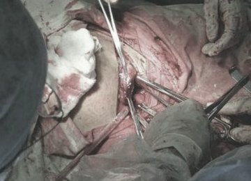 人体探秘：实拍剖腹产震撼生产过程