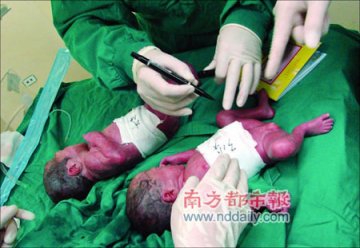 父亲因经济窘迫欲放弃四胞胎组图
