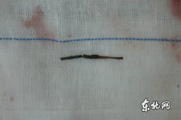 男子4公分长钉存脑内15年致癫痫反复发作
