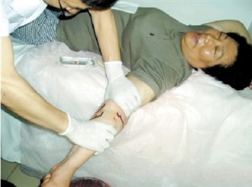 中医放血850毫升治病引争议 专家质疑其科学性