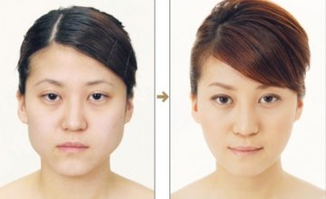 日本整形医院惊悚整容对比照大曝光