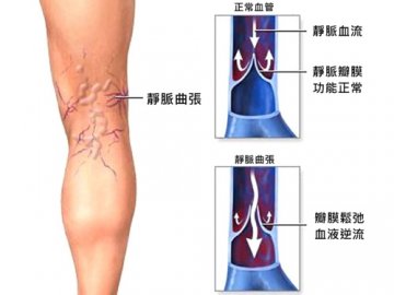 军医讲解：腿上“蚯蚓”静脉曲张的治疗方法