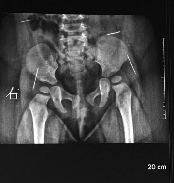 女婴体内留针事件被刑事立案