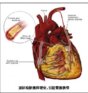 急性冠脉综合征的抗栓治疗