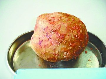 壮男膀胱内取出1公斤结石 身怀多年竟不知