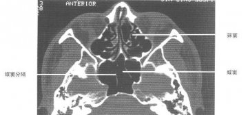 正常鼻咽鼻窦CT（3）