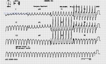 室速伴不明确的房室分离Ventricular tachycardia with subtle AV dissociation