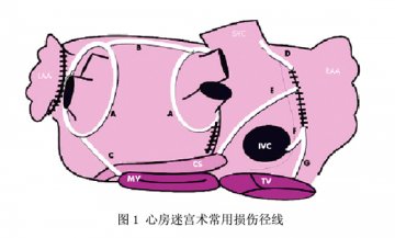 心房颤动外科治疗的进展