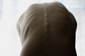 与脊柱矫正器相伴的少女青春时光
