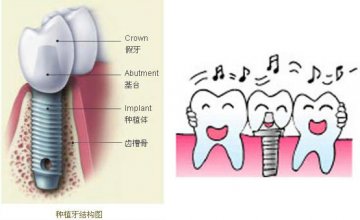 军医提示：牙周病患者也能接受牙齿种植