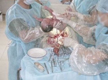 人体探秘：实拍剖腹产震撼生产过程