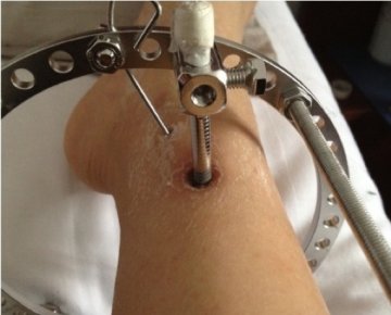 女子为矫正O型腿 在腿上钉螺丝