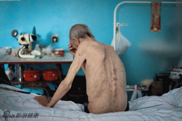 传染病死亡率排行榜中，肺结核排名第二