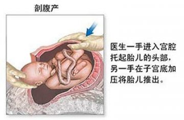女性剖腹产手术全过程图解