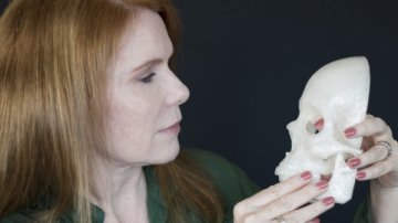 技术宅用3D打印帮助妻子治疗脑瘤