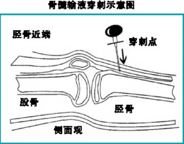 紧急输液方式之骨髓内输液