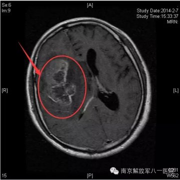 警惕：记忆力下降半年，元凶竟是脑癌