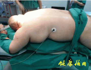临床快递：湘雅专家成功为280斤“巨胖”男子施高位截瘫术