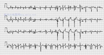 心脏移植（双心脏）Piggy-back heart transplant