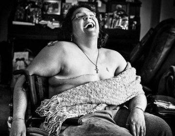 因乳腺癌切除胸部的女人