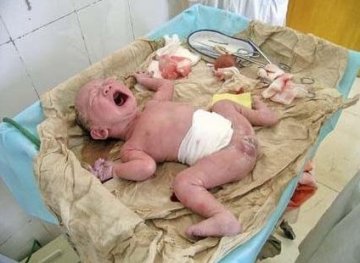 人体探秘：实拍剖腹产震撼生产过程