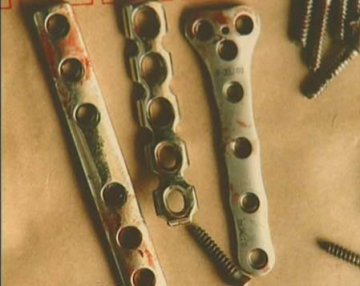 患者体内医疗钢板3次断裂致终身残疾