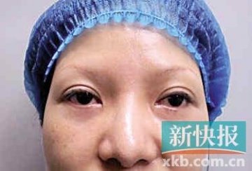 整形去眼袋竟被整成“僵尸眼”