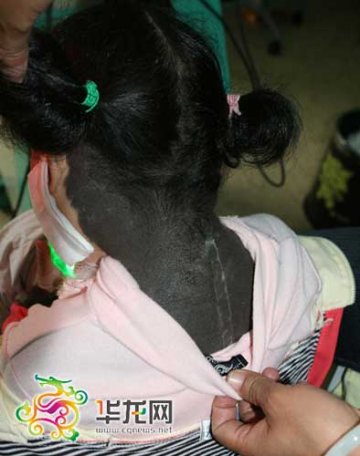 四岁女孩全身五分之一面积长黑痣黑毛