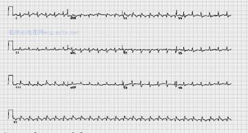 急性肺栓塞Acute pulmonary embolus