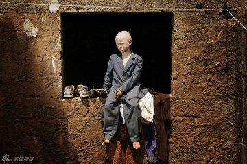 非洲白化病