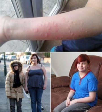 英国少女得怪病对冷空气过敏