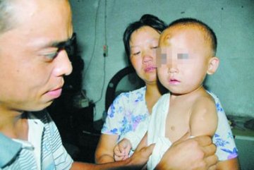 男童患罕见“石人”综合征 被碰后肉变硬成骨头