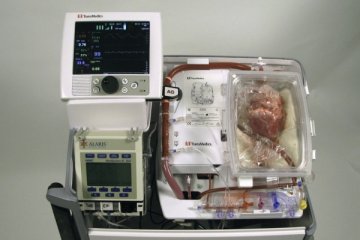 澳大利亚医生成功移植死亡心脏 为全球首例