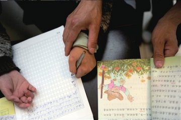 双手被养母砍断九龄童赴北京求医