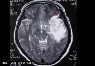 颞叶胶质瘤切除术