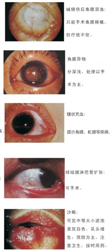 碱烧伤后角膜混浊、角膜异物、睫状充血、球结膜淋巴管扩张、沙眼