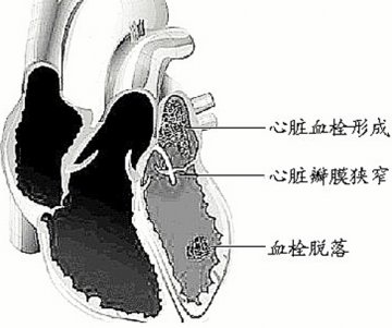 心外科手术前后须防血栓