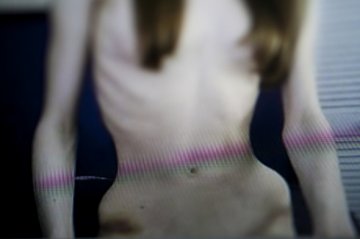 实拍厌食症患者的身体