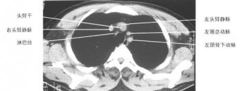 正常胸部纵隔窗CT（4）