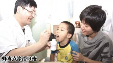 蜂毒点涂治口疮