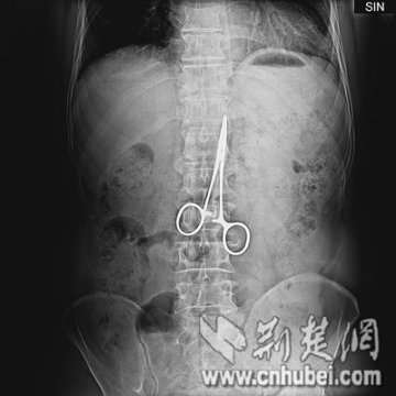 医用止血钳藏患者腹腔中37年未造成大伤害