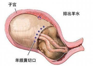 女性剖腹产手术全过程图解