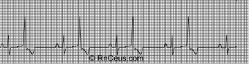 室早Ventricular premature beats