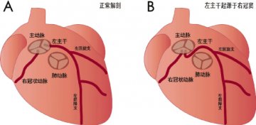 儿童猝死“寻凶”—— 冠状动脉左主干起源异常