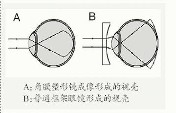 近视 光学矫正效果几何