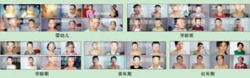太原斜颈病医院美创游离松解术彻底突破肌性斜颈的治疗